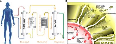 Case Report: Efficacy of albumin dialysis for the reversal of bile cast nephropathy-induced acute kidney injury